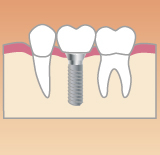 歯が一本ない場合のインプラント