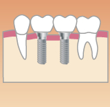 歯が2本ない場合のインプラント