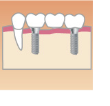 歯が3本ない場合のインプラント
