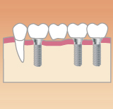 歯が四本ない場合のインプラント