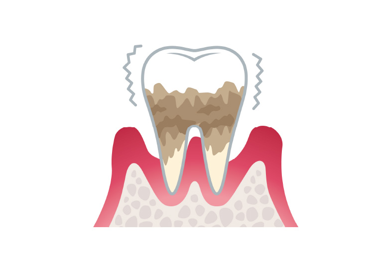 早期の歯周病治療が大切です